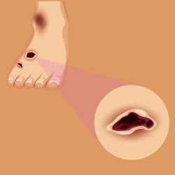 Unha Encravada E Patologias Da Podologia